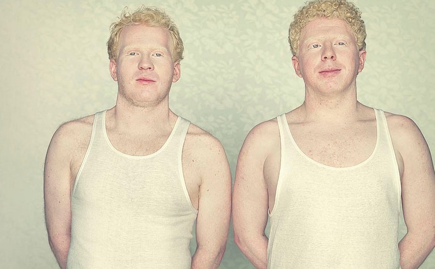 Casos de albinismo