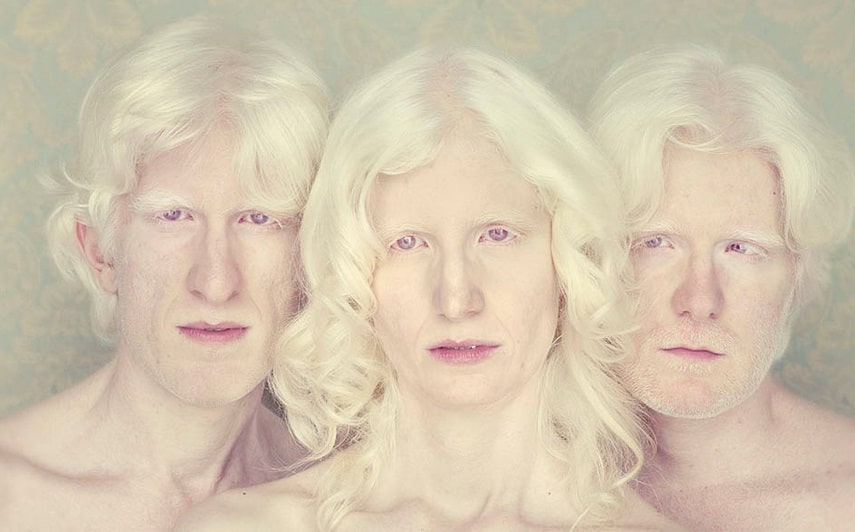 Casos de albinismo